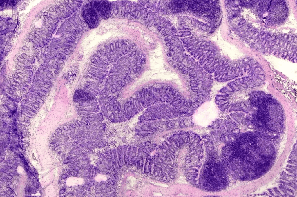 Featured image for Multiple inflammatory processes shape chronic bowel disease